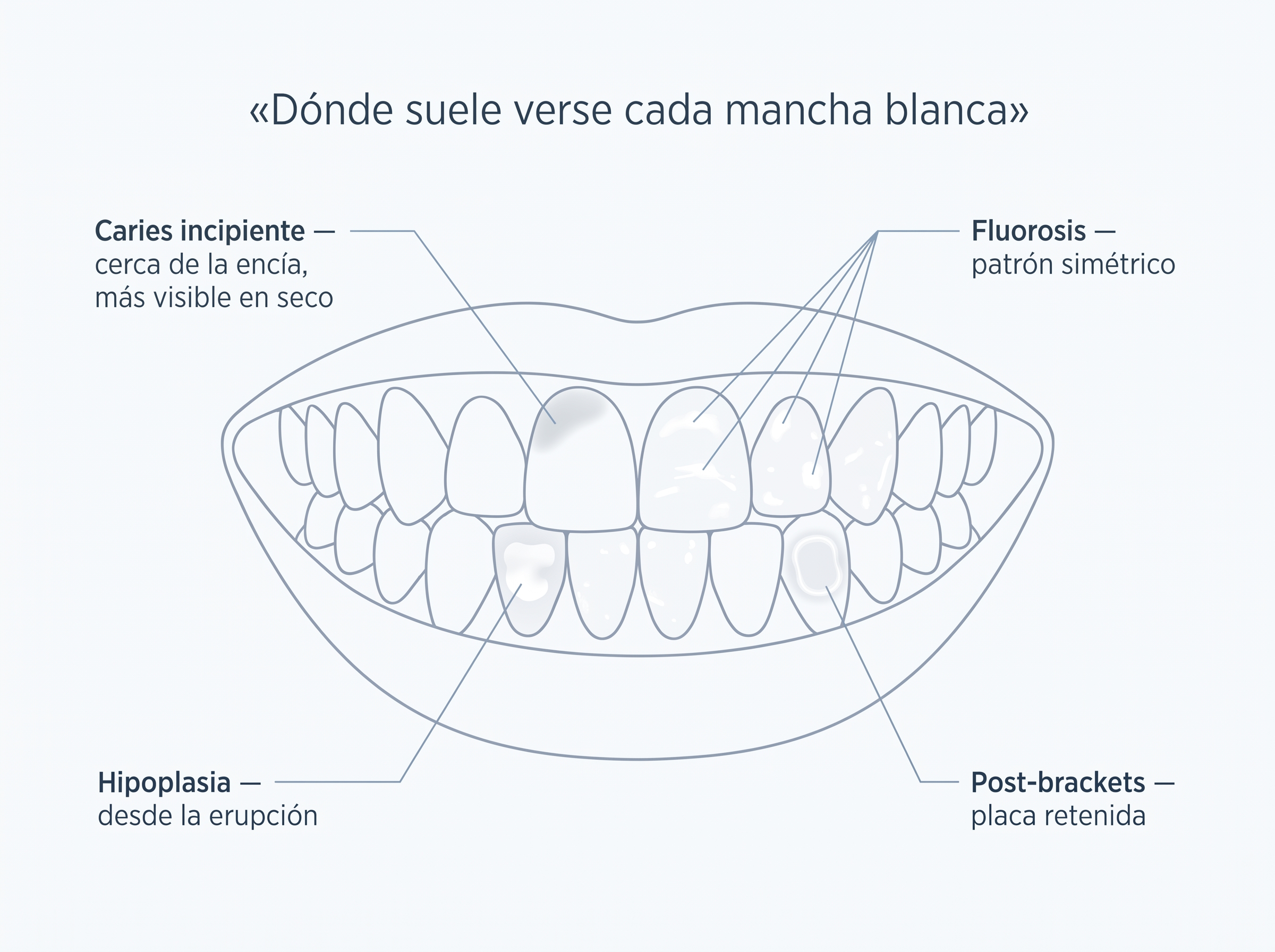 Mapa esquemático de una sonrisa que sitúa caries incipiente, fluorosis, hipoplasia y manchas post-brackets.