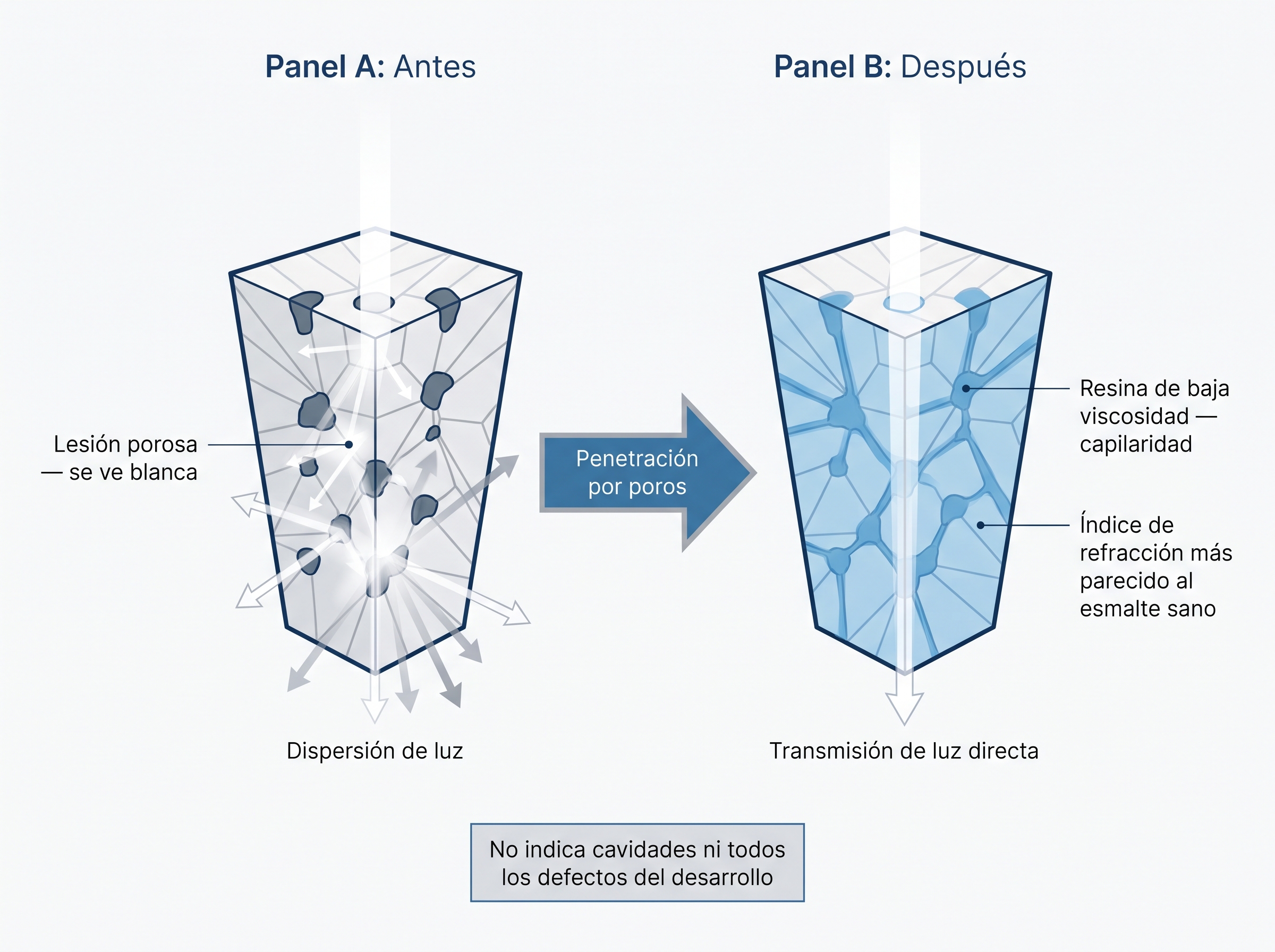 Antes y después de la infiltración: poros del esmalte vacíos frente a poros rellenos de resina que disminuyen la opacidad.